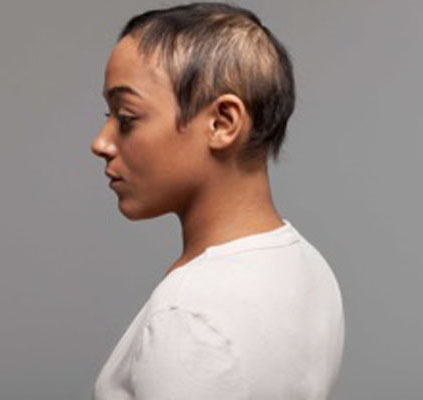 Alopecia-Hair-Loss Alopecia Hair Loss